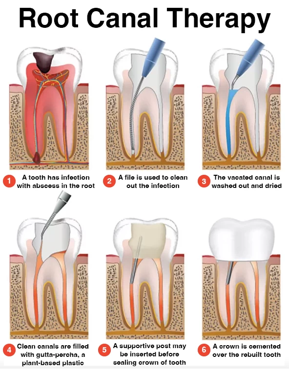 normal root canal