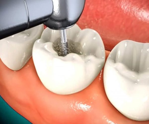 root canal root canal