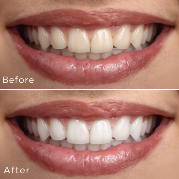 Dental Veneers Belleville